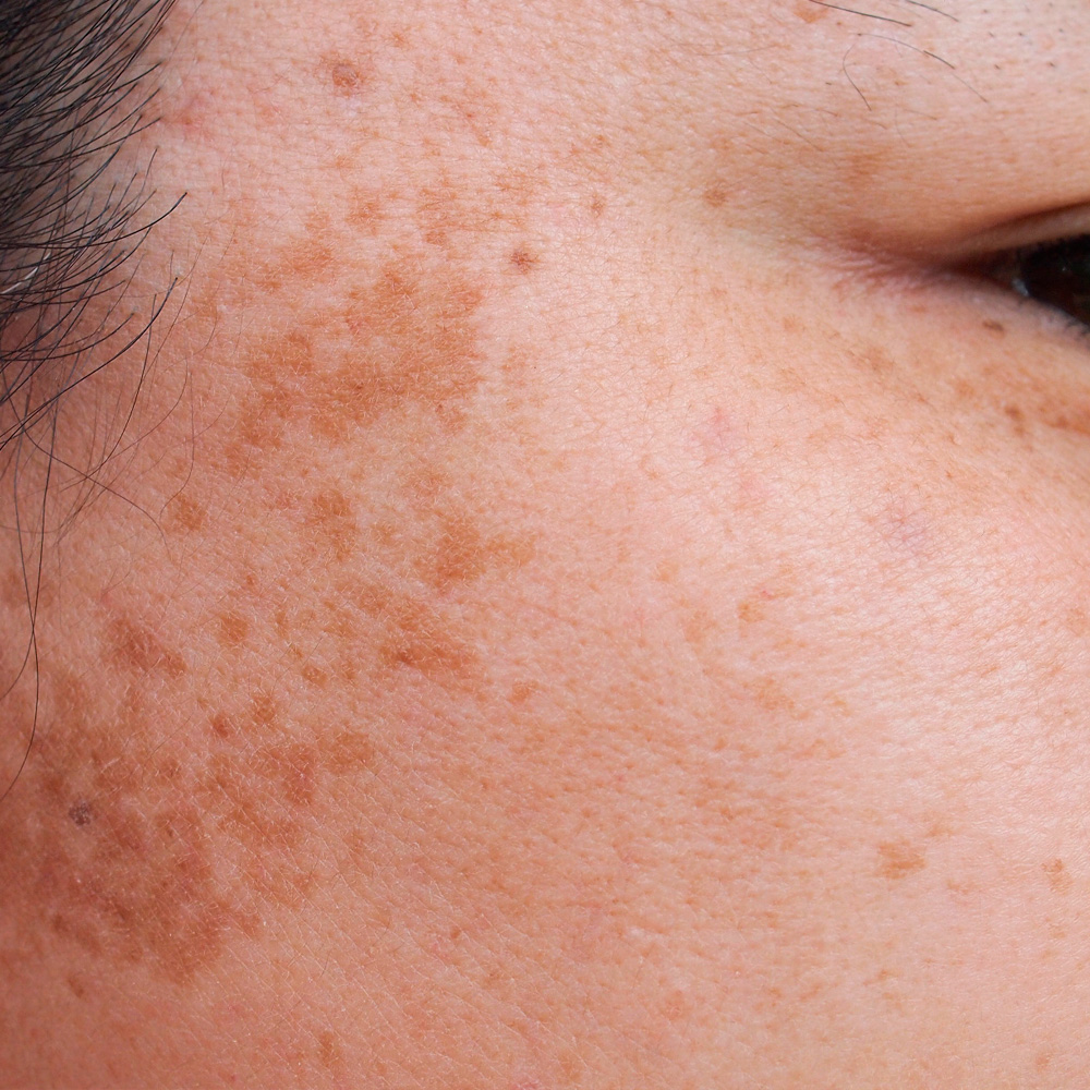 Manchas en la piel