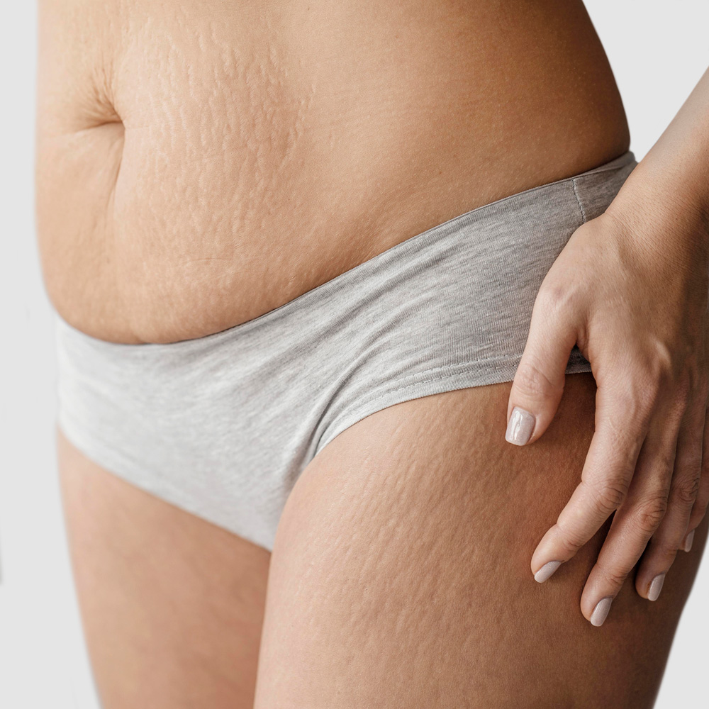 Remodelación Corporal