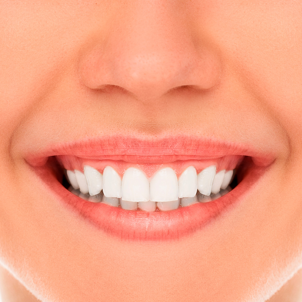 Sonrisa gingival