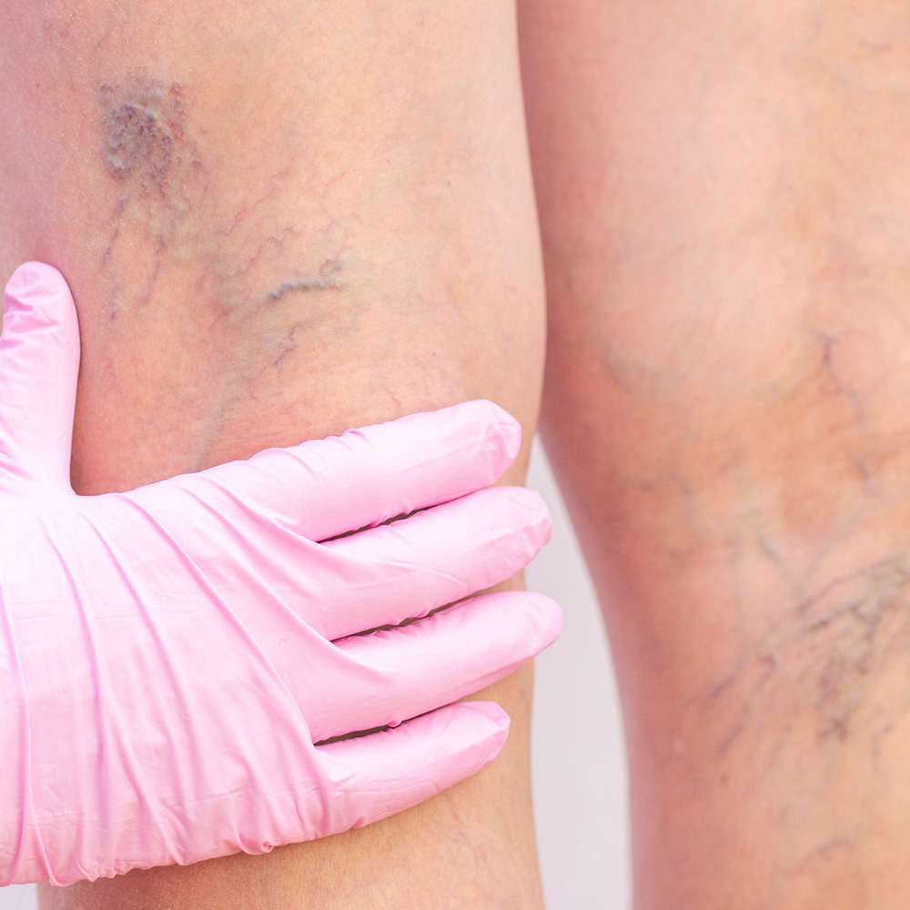 Varices y Arañas Vasculares